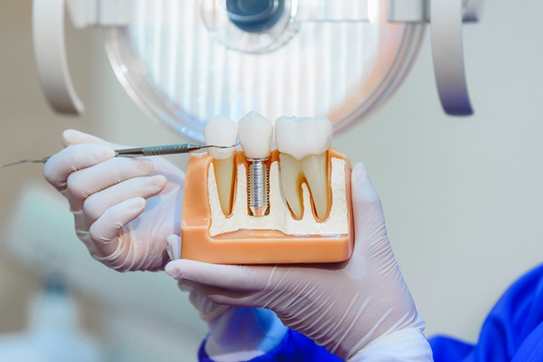 How An Experienced Implant Dentist Can Improve Your Smile