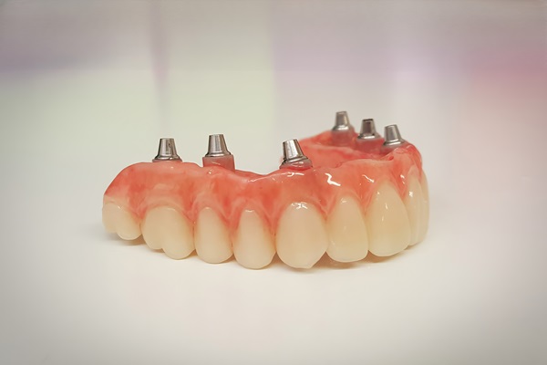 Comparing Implant Supported Dentures With Traditional Dentures